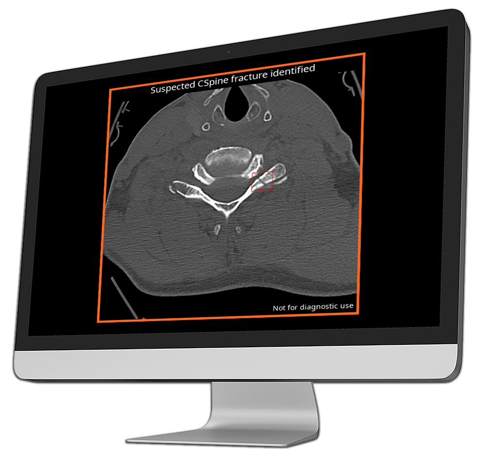 ai radiology output into computer-cspine (2)
