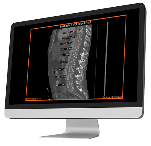 medical image showing suspected vcf details.