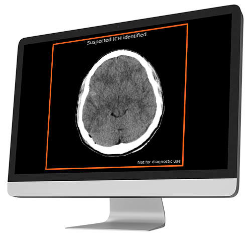 ct scan indicating suspected ich