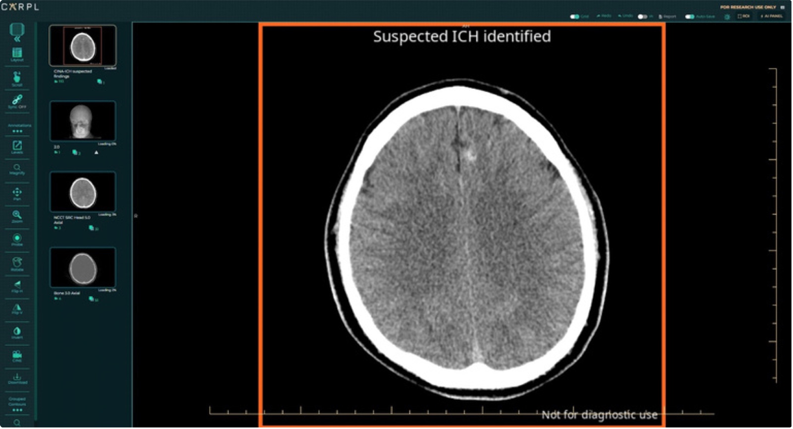 ai output of avicenna.ai's ich solution on the carpl universal ai viewer, showing a suspected intracranial hemorrhage on a head ct