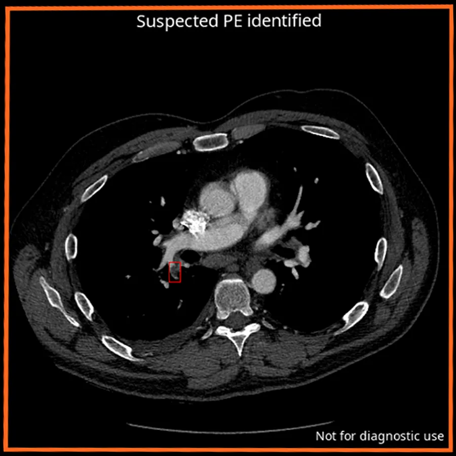 published cina-pe example output: suspected pe identified, not for diagnostic use