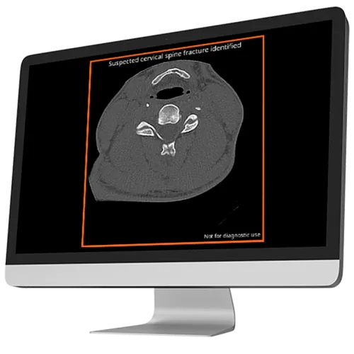 Cervical spine fracture 2 cina-cspine output in the united states