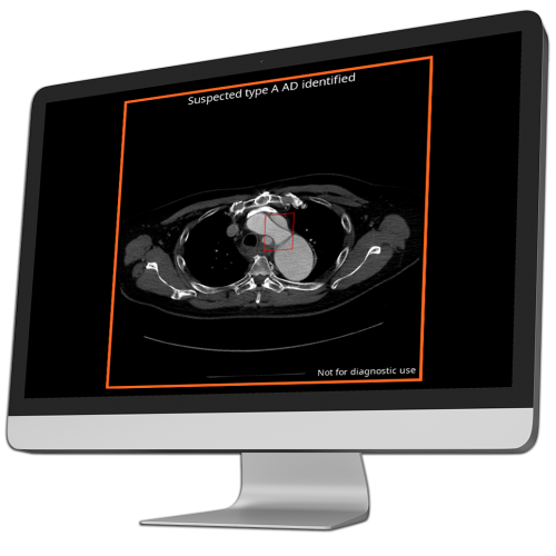 ct scan with suspected type a ad