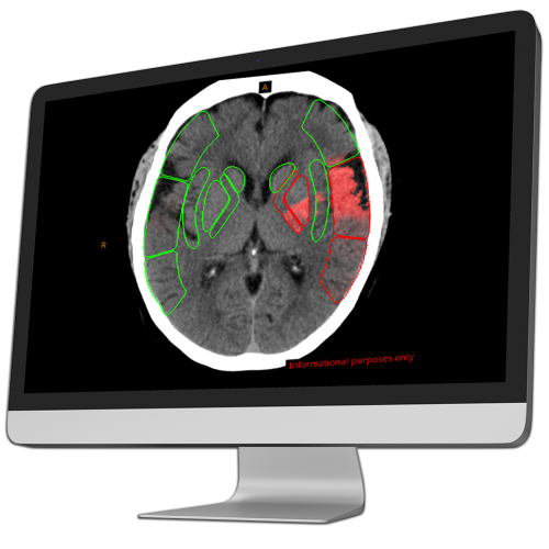 brain scan with highlighted areas