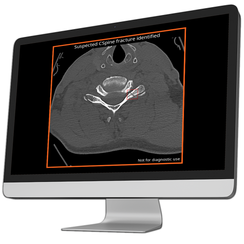 ct scan showing suspected cspine fracture