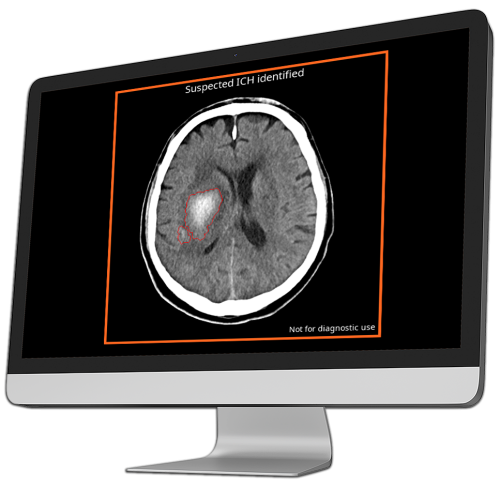 ct scan showing suspected intracranial hemorrhage