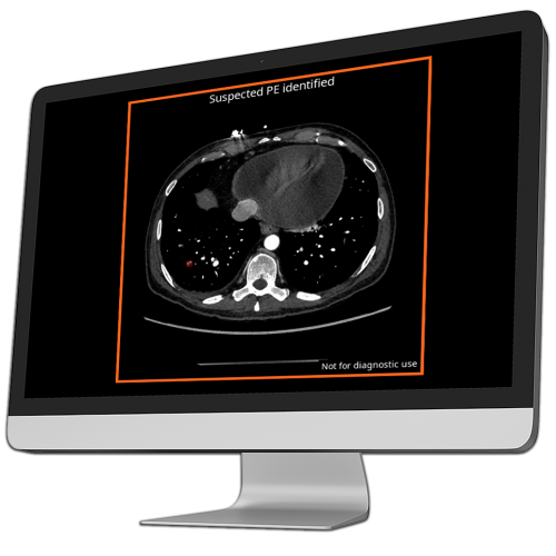 ct scan showing suspected pulmonary embolism