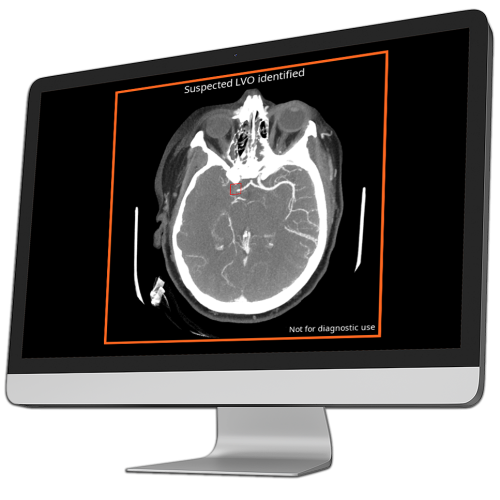 ct scan showing suspected lvo