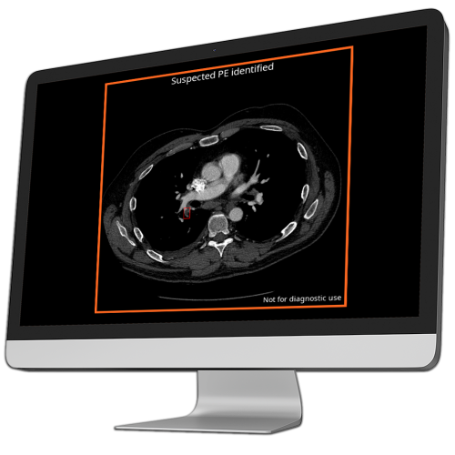 ct scan showing suspected pulmonary embolism